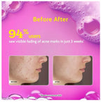 Chemist at Play 2% Salicylic Acid Face Wash | Acne & Oil Control For Oily Skin