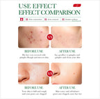 BIOAQUA Salicylic Acid Acne Removal Essence Shrinks Pores Soothing Redness Fade Acne Marks